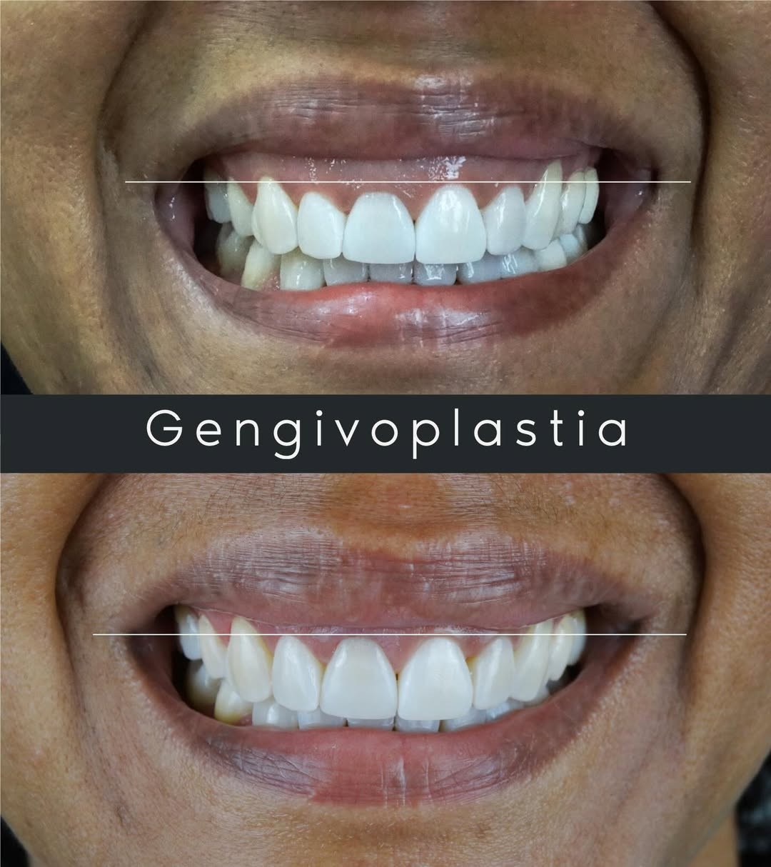 Gengivoplastia — antes e depois com Dr. Emerson Ferreira